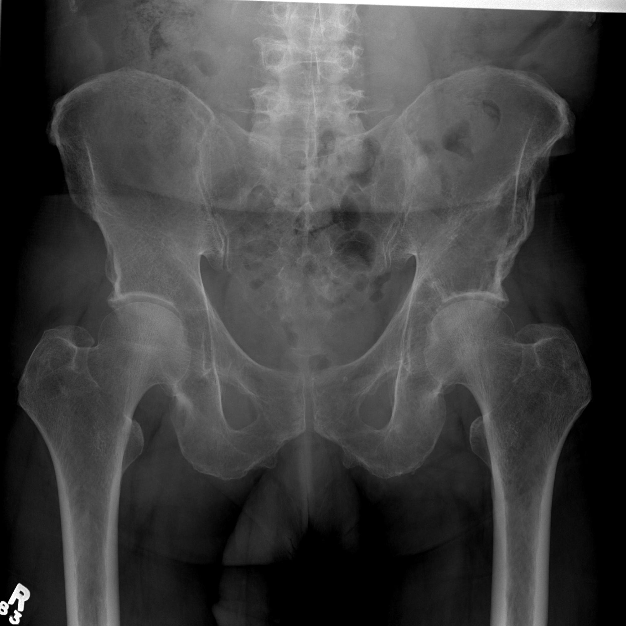 Multiple Myeloma Diffuse Osteopenia